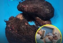 Israël : des chirurgiens retirent une énorme boule de cheveux de l’estomac d’un enfant – la rare « syndrome de Raiponce »